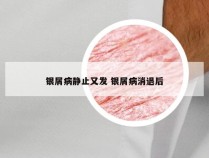 银屑病静止又发 银屑病消退后