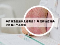 牛皮癣治愈后头上还有几个 牛皮癣治愈后头上还有几个小疙瘩
