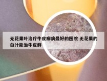 无花果叶治疗牛皮癣病最好的医院 无花果的白汁能治牛皮鲜