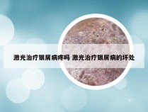 激光治疗银屑病疼吗 激光治疗银屑病的坏处