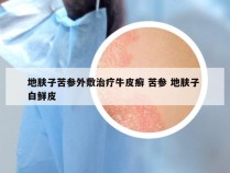 地肤子苦参外敷治疗牛皮癣 苦参 地肤子 白鲜皮