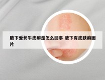 腋下爱长牛皮癣是怎么回事 腋下有皮肤癣图片