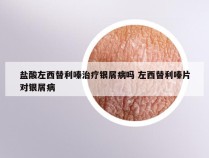 盐酸左西替利嗪治疗银屑病吗 左西替利嗪片对银屑病