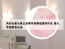 为什么老人身上全有牛皮癣这是为什么 老人牛皮鲜怎么治