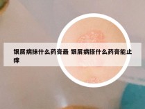 银屑病抹什么药膏最 银屑病搽什么药膏能止痒