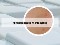 牛皮癣很痛苦吗 牛皮皮癣疼吗
