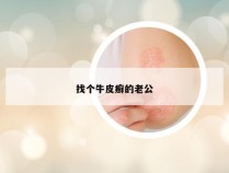 找个牛皮癣的老公