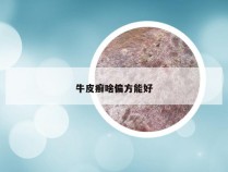 牛皮癣啥偏方能好