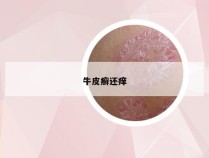 牛皮癣还痒