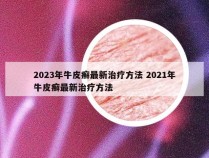 2023年牛皮癣最新治疗方法 2021年牛皮癣最新治疗方法