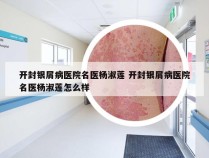 开封银屑病医院名医杨淑莲 开封银屑病医院名医杨淑莲怎么样