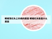 眼睛发红头上长癣的原因 眼睛红头胀是什么原因