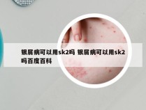 银屑病可以用sk2吗 银屑病可以用sk2吗百度百科