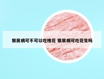 银屑病可不可以吃槐花 银屑病可吃花生吗