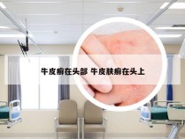 牛皮癣在头部 牛皮肤癣在头上