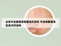 全身牛皮癣爆发需要抹药膏吗 牛皮癣要爆发出来才好治吗