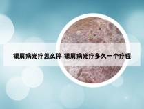银屑病光疗怎么停 银屑病光疗多久一个疗程