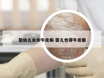 婴幼儿会长牛皮癣 婴儿也得牛皮廨