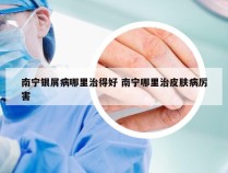 南宁银屑病哪里治得好 南宁哪里治皮肤病厉害