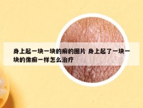 身上起一块一块的癣的图片 身上起了一块一块的像癣一样怎么治疗