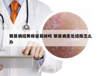 银屑病结黄痂容易掉吗 银屑病患处结痂怎么办