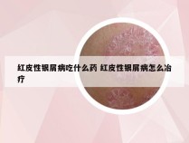 红皮性银屑病吃什么药 红皮性银屑病怎么冶疗