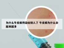 为什么牛皮癣传染给别人了 牛皮癣为什么会越来越多