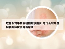 吃什么对牛皮癣初期症状图片 吃什么对牛皮癣初期症状图片有帮助
