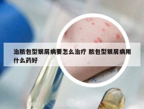 治脓包型银屑病要怎么治疗 脓包型银屑病用什么药好