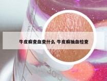 牛皮癣查血查什么 牛皮癣抽血检查