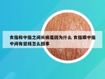 食指和中指之间长癣是因为什么 食指跟中指中间有竖线怎么回事