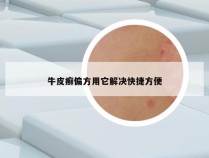 牛皮癣偏方用它解决快捷方便