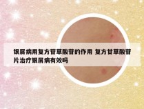 银屑病用复方苷草酸苷的作用 复方甘草酸苷片治疗银屑病有效吗