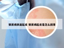 银屑病表面起皮 银屑病起皮是怎么回事