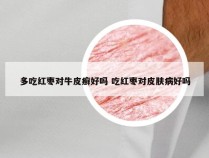 多吃红枣对牛皮癣好吗 吃红枣对皮肤病好吗