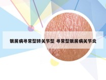银屑病寻常型转关节型 寻常型银屑病关节炎