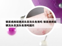 银屑病用硫磺洗头膏洗头有用吗 银屑病用硫磺洗头膏洗头有用吗图片