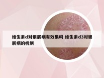 维生素d对银屑病有效果吗 维生素d3对银屑病的机制