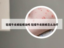 轻度牛皮癣能根治吗 轻度牛皮肤癣怎么治疗