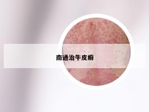 南通治牛皮癣