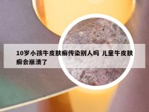 10岁小孩牛皮肤癣传染别人吗 儿童牛皮肤癣会崩溃了