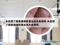 头皮得了银屑病用陈爱水洗头有用吗 头皮得了银屑病用陈爱水洗头有用吗