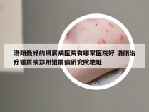 洛阳最好的银屑病医院有哪家医院好 洛阳治疗银屑病郑州银屑病研究院地址