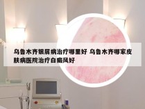 乌鲁木齐银屑病治疗哪里好 乌鲁木齐哪家皮肤病医院治疗白癜风好