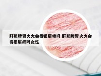 肝胆脾胃火大会得银屑病吗 肝胆脾胃火大会得银屑病吗女性