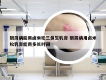 银屑病能用卤米松三氯生乳膏 银屑病用卤米松乳膏能用多长时间