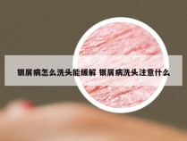 银屑病怎么洗头能缓解 银屑病洗头注意什么