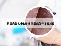 银屑病怎么让他断根 银屑病怎样才能减轻
