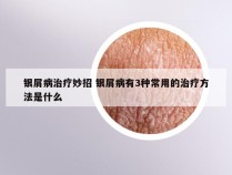 银屑病治疗妙招 银屑病有3种常用的治疗方法是什么