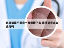 银屑病是不是会一直遗传下去 银屑病肯定会遗传吗